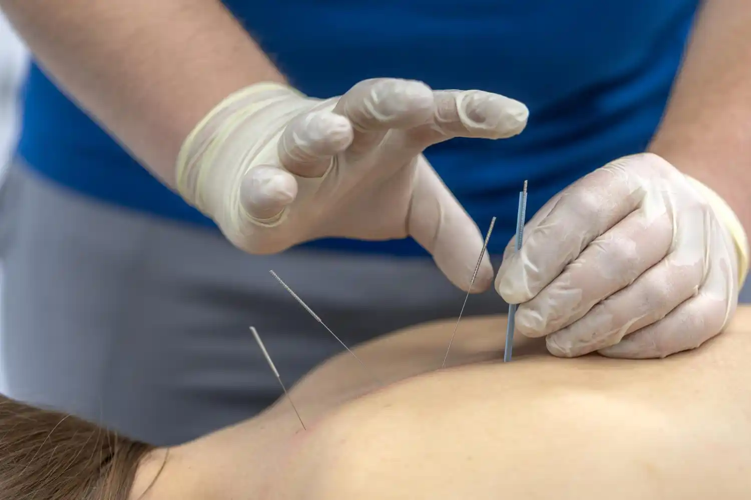 Acupuncture therapy for neck and shoulder pain